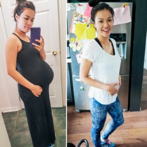 1 year postpartum Diastasis 